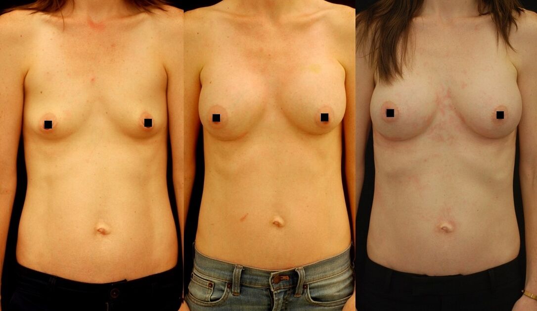 Le résultat de l'augmentation mammaire par injection. 